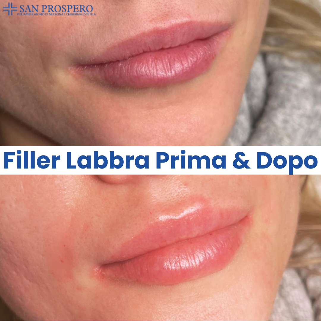 prima e dopo filler labbra1